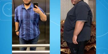 تكميم المعدة في ايران