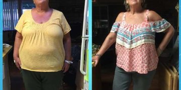 نتيجة عملية تكميم المعدة في إيران بعد 5 أشهر