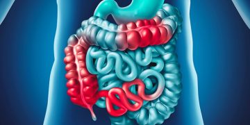 انسداد معوي (علوص) بعد جراحة إنقاص الوزن في إيران