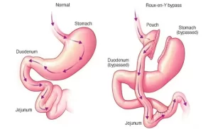 Classic gastric bypass