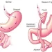 Classic gastric bypass