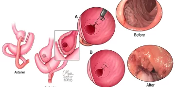 استعادة الوزن بعد جراحة إنقاص الوزن في إيران