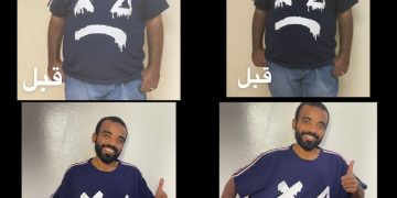 نتيجة عملية تكميم المعدة في إيران