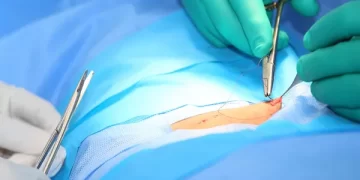 تبقى الغرز بعد جراحة انقاص الوزن في إيران