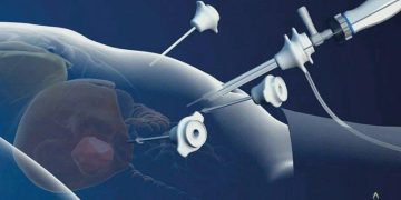 تنظير البطن