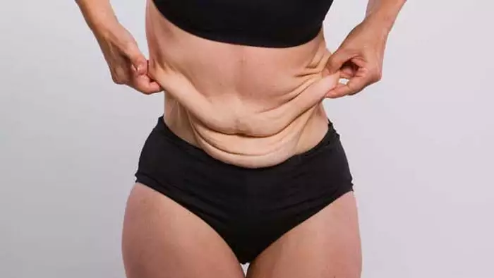 الجلد المترهل هو أحد الآثار الجانبية الأخرى لجراحة المعدة لفقدان الوزن