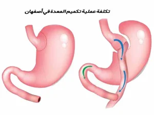 تكلفة عملية تكميم المعدة في أصفهان