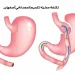 تكلفة عملية تكميم المعدة في أصفهان