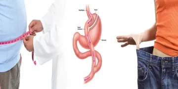 ماذا تفيدنا تجارب من قاموا بإجراء عملية تحويل مسار المعدة؟