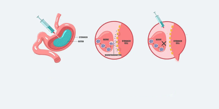 آلام في البطن بعد حقن البوتوكس في المعدة