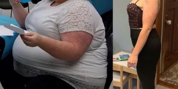 عملية تحويل مسار المعدة