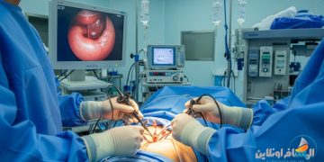 عملية تكميم المعدة